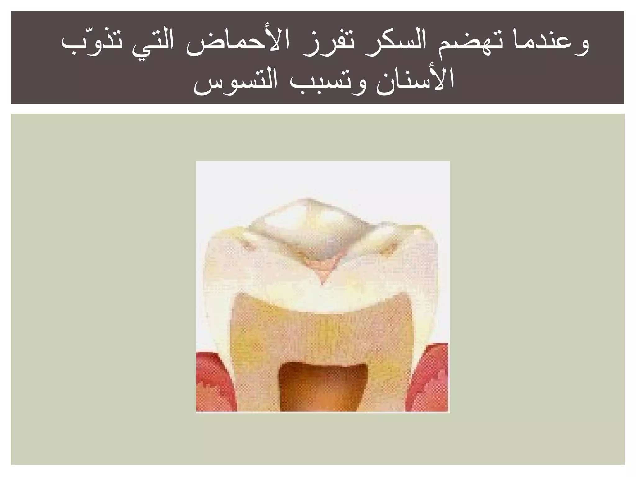 الوقاية من تسوس الأسنان وإلتهاب اللثة | POT