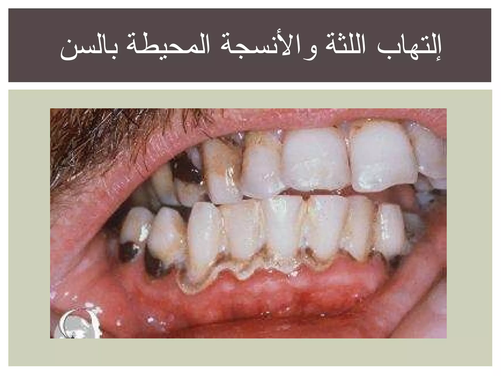 الوقاية من تسوس الأسنان وإلتهاب اللثة | POT