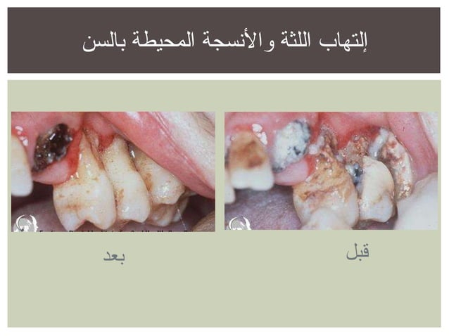 الوقاية من تسوس الأسنان وإلتهاب اللثة | POT