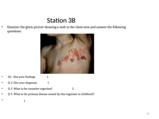 27
Station 3B
• Examine the given picture showing a rash in the chest area and answer the following
questions:
• Q.1 Give your findings. 1
• Q. 2 Give your diagnosis. 1
• Q. 3 What is the causative organism? 2
• Q. 4 What is the primary disease caused by this organism in childhood?
• 1
 