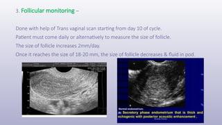 3. Follicular monitoring –
Done with help of Trans vaginal scan starting from day 10 of cycle.
Patient must come daily or alternatively to measure the size of follicle.
The size of follicle increases 2mm/day.
Once it reaches the size of 18-20 mm, the size of follicle decreases & fluid in pod.
 