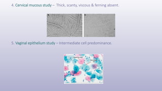 4. Cervical mucous study – Thick, scanty, viscous & ferning absent.
5. Vaginal epithelium study – Intermediate cell predominance.
 