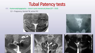 Tubal Patency tests
IOC- Hysterosalpingography – done in post menstrual phase (D7 – D10)
C/I – Pregnancy, Genital TB, active PID
 