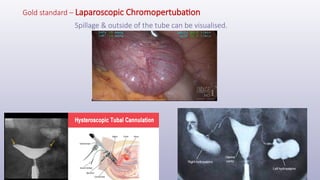 Gold standard – Laparoscopic Chromopertubation
Spillage & outside of the tube can be visualised.
 