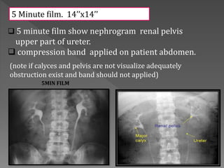  5 minute film show nephrogram renal pelvis
upper part of ureter.
 compression band applied on patient abdomen.
(note if calyces and pelvis are not visualize adequately
obstruction exist and band should not applied)
5 Minute film. 14’’x14’’
5MIN FILM
 