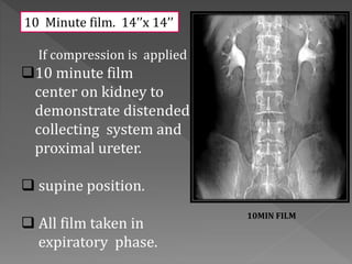 If compression is applied
10 minute film
center on kidney to
demonstrate distended
collecting system and
proximal ureter.
 supine position.
 All film taken in
expiratory phase.
10 Minute film. 14’’x 14’’
10MIN FILM
 