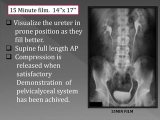  Visualize the ureter in
prone position as they
fill better.
 Supine full length AP
 Compression is
released when
satisfactory
Demonstration of
pelvicalyceal system
has been achived.
15 Minute film. 14’’x 17’’
15MIN FILM
 