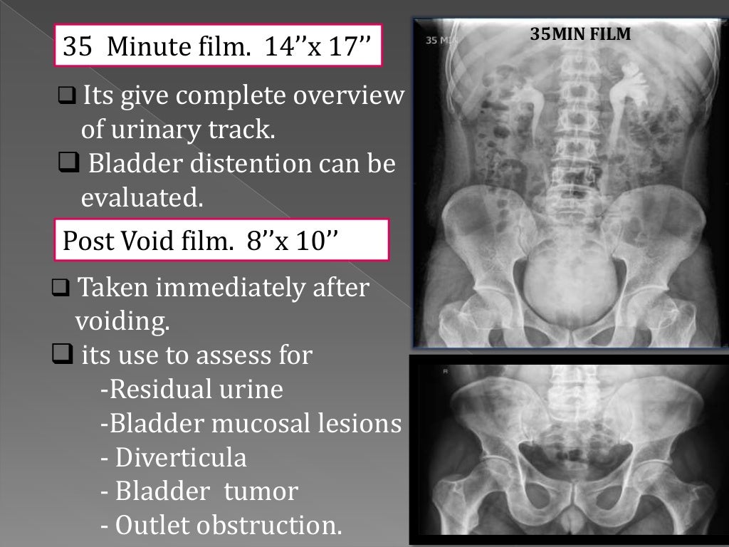 INTRAVENOUS UROGRAM