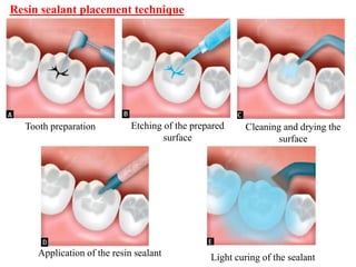 Resin sealant placement technique
Tooth preparation Etching of the prepared
surface
Cleaning and drying the
surface
Application of the resin sealant Light curing of the sealant
 