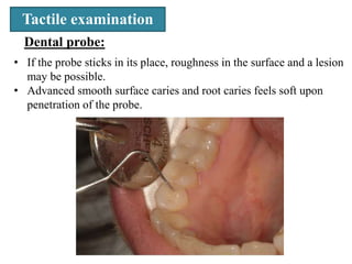 Tactile examination
• If the probe sticks in its place, roughness in the surface and a lesion
may be possible.
• Advanced smooth surface caries and root caries feels soft upon
penetration of the probe.
Dental probe:
 