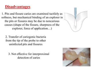 1. Pits and fissure caries are examined tactilely as
softness, but mechanical binding of an explorer in
the pits or fissures may be due to noncarious
causes (shape of the fissure, sharpness of the
explorer, force of application…)
Disadvantages
3. Not effective for interproximal
detection of caries
2. Transfer of cariogenic bacteria
from the tip of the probe to other
uninfected pits and fissures
 