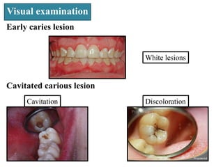 Visual examination
Cavitation
Early caries lesion
Discoloration
White lesions
Cavitated carious lesion
 
