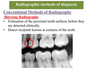 Conventional Methods of Radiography
Bitewing Radiographs
• Estimation of the proximal tooth surfaces before they
are detected clinically.
• Detect incipient lesions at contacts of the teeth.
Radiographic methods of diagnosis
 
