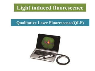 Qualitative Laser Fluorescence(QLF)
Light induced fluorescence
 