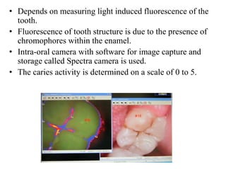 • Depends on measuring light induced fluorescence of the
tooth.
• Fluorescence of tooth structure is due to the presence of
chromophores within the enamel.
• Intra-oral camera with software for image capture and
storage called Spectra camera is used.
• The caries activity is determined on a scale of 0 to 5.
 