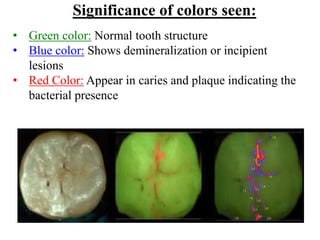 Significance of colors seen:
• Green color: Normal tooth structure
• Blue color: Shows demineralization or incipient
lesions
• Red Color: Appear in caries and plaque indicating the
bacterial presence
 