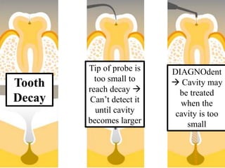 Tooth
Decay
Tip of probe is
too small to
reach decay 
Can’t detect it
until cavity
becomes larger
DIAGNOdent
 Cavity may
be treated
when the
cavity is too
small
 