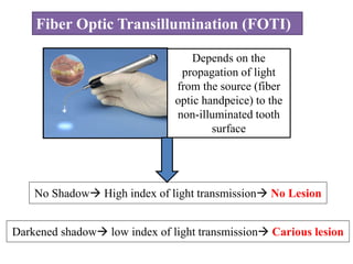 Fiber Optic Transillumination (FOTI)
Depends on the
propagation of light
from the source (fiber
optic handpeice) to the
non-illuminated tooth
surface
No Shadow High index of light transmission No Lesion
Darkened shadow low index of light transmission Carious lesion
 
