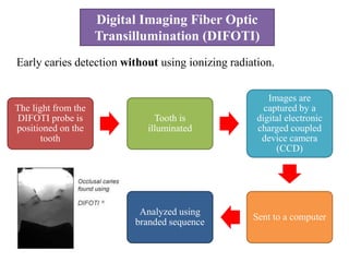 Digital Imaging Fiber Optic
Transillumination (DIFOTI)
Early caries detection without using ionizing radiation.
The light from the
DIFOTI probe is
positioned on the
tooth
Tooth is
illuminated
Images are
captured by a
digital electronic
charged coupled
device camera
(CCD)
Sent to a computer
Analyzed using
branded sequence
 