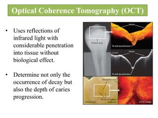 Optical Coherence Tomography (OCT)
• Uses reflections of
infrared light with
considerable penetration
into tissue without
biological effect.
• Determine not only the
occurrence of decay but
also the depth of caries
progression.
 