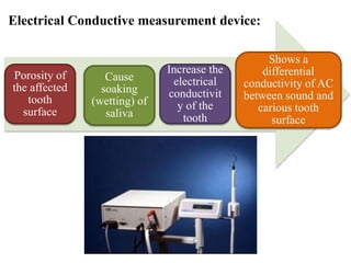 Electrical Conductive measurement device:
Porosity of
the affected
tooth
surface
Cause
soaking
(wetting) of
saliva
Increase the
electrical
conductivit
y of the
tooth
Shows a
differential
conductivity of AC
between sound and
carious tooth
surface
 