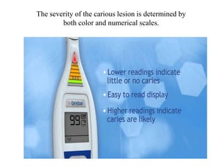 The severity of the carious lesion is determined by
both color and numerical scales.
 