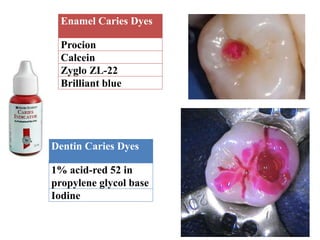 Enamel Caries Dyes
Procion
Calcein
Zyglo ZL-22
Brilliant blue
Dentin Caries Dyes
1% acid-red 52 in
propylene glycol base
Iodine
 