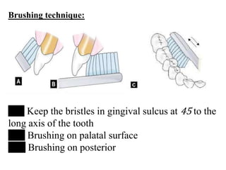 Brushing technique:
A Keep the bristles in gingival sulcus at 45 to the
long axis of the tooth
B Brushing on palatal surface
C Brushing on posterior
 