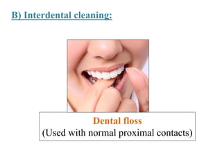 B) Interdental cleaning:
Dental floss
(Used with normal proximal contacts)
 