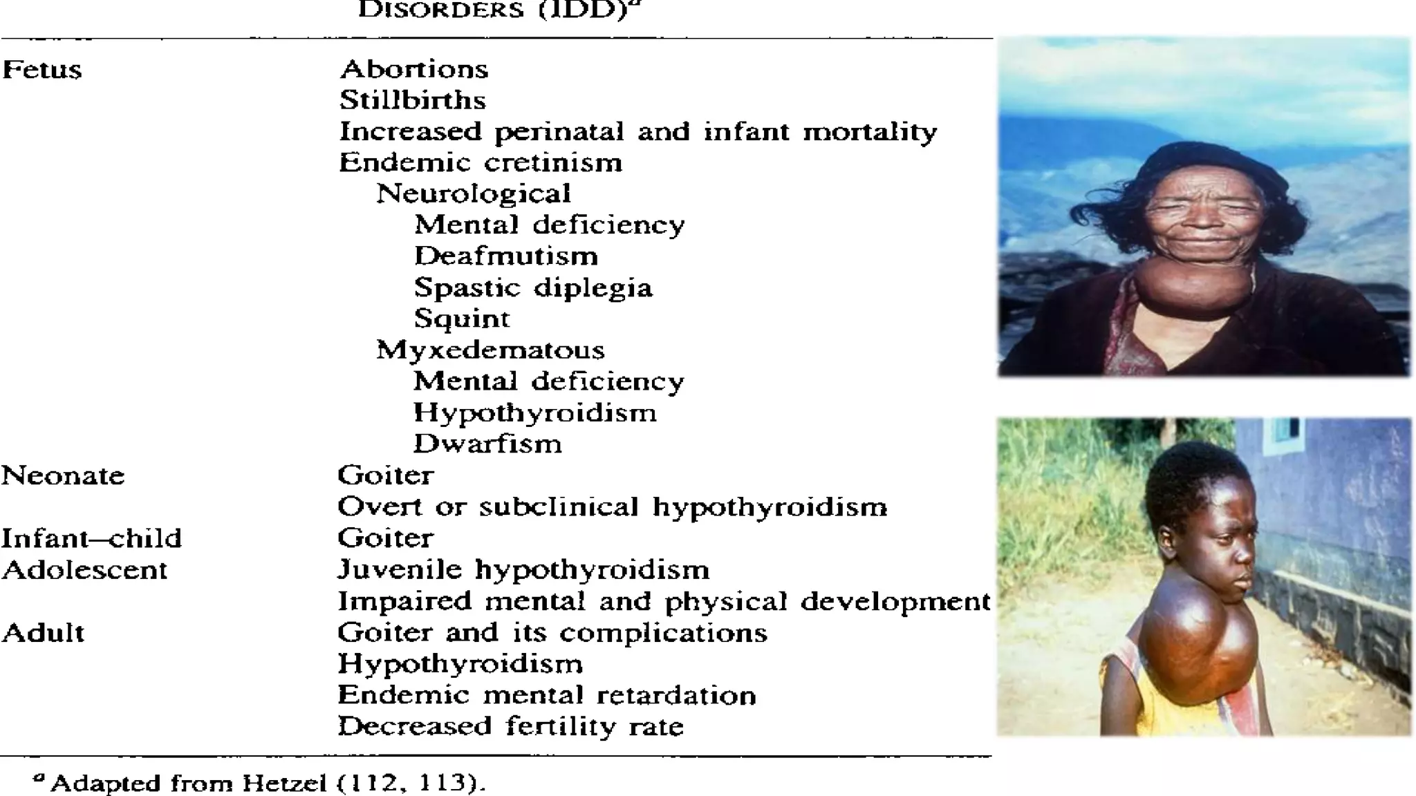 Iodine deficiency disorders | PPTX