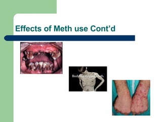Effects of Meth use Cont’d 