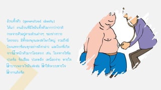 อ้วนทังตัว (generalized obesity)
ได้แก่ คนอ้วนที่มีไขมันทังตัวมากกว่าปกติ
กระจายตัวอยู่ตามส่วนต่างๆ ของร่างกาย
โดยรอบ มีทังลงพุงและสะโพกใหญ่ รวมถึงมี
โรคแทรกซ้อนทุกอย่างดังกล่าว และโรคที่เกิด
จากนาหนักตัวมากโดยตรง เช่น โรคทางไขข้อ
ปวดข้อ ข้อเสื่อม ปวดหลัง เหนื่อยง่าย หายใจ
ลาบากเพราะไขมันสะสม ทาให้ระบบหายใจ
ทางานติดขัด
 