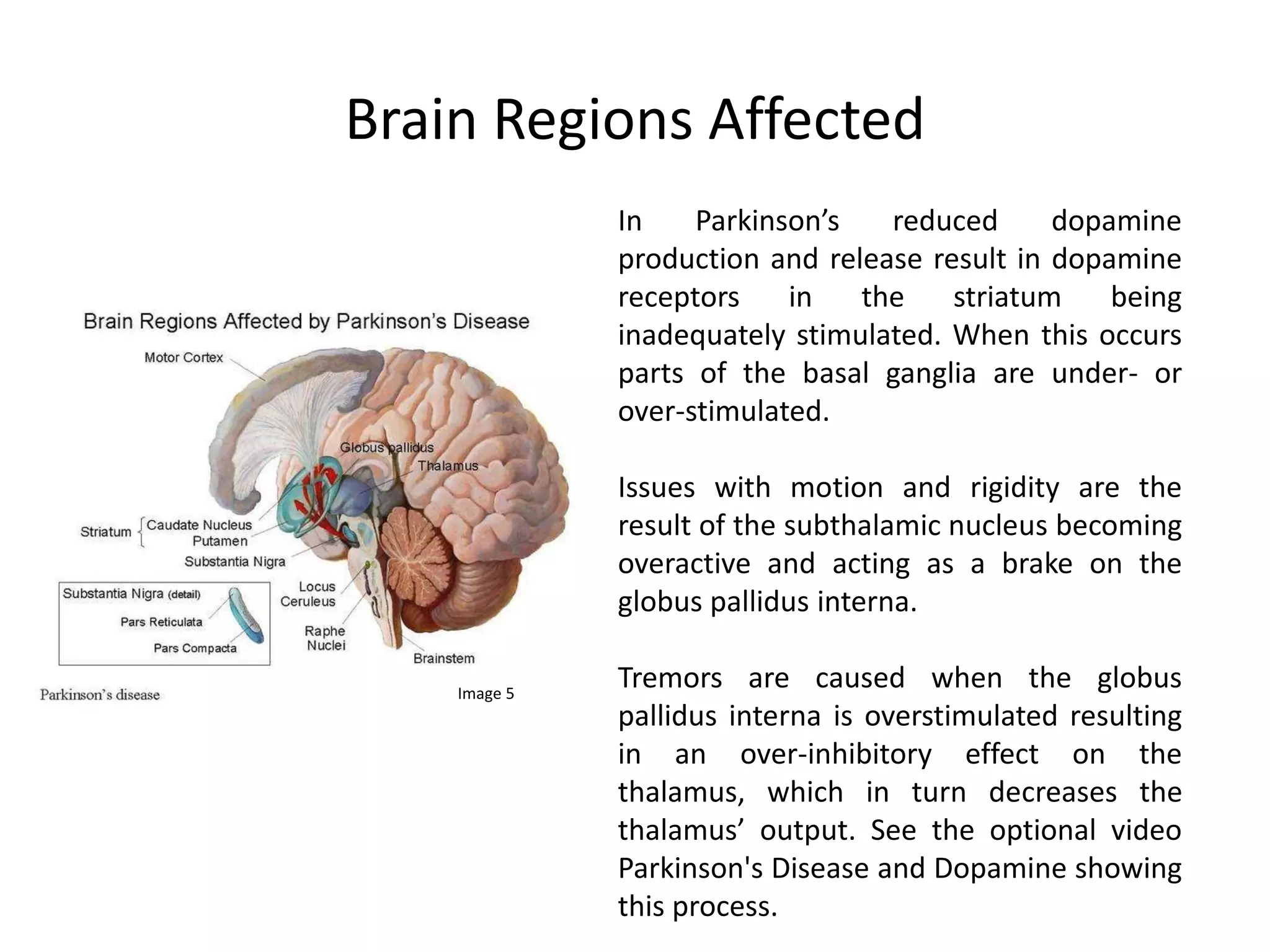 Understanding the Brain: Final Project - Parkinson’s Disease | PPSX