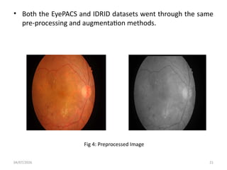 Deep Learning Architecture for Accurate Diabetes Detection via Retinal ...