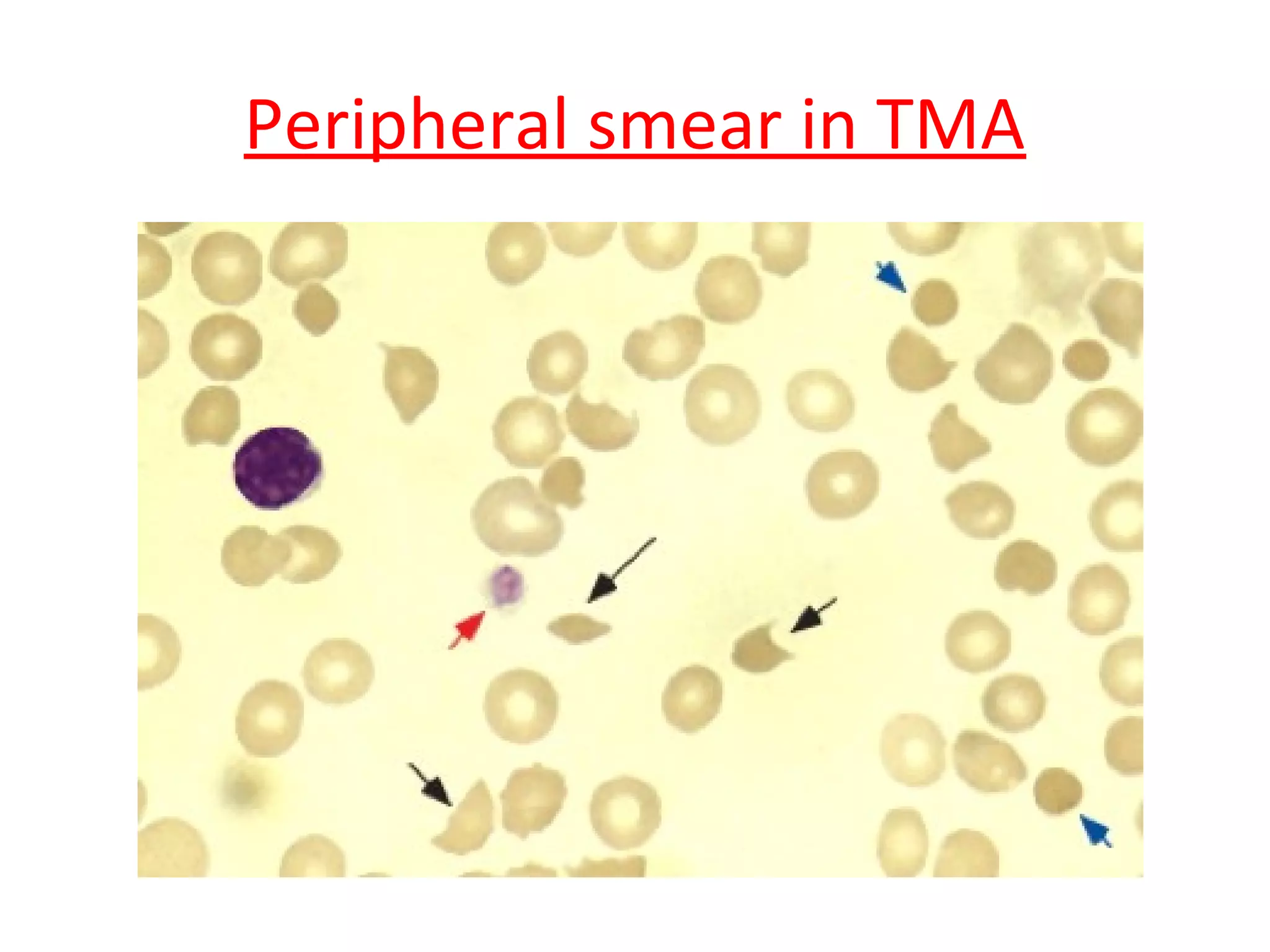 Thrombotic Microangiopathy | PPT