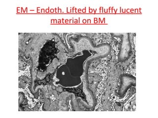 EM – Endoth. Lifted by fluffy lucent
material on BM
 