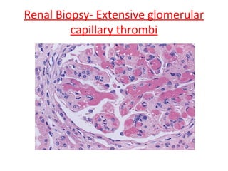 Renal Biopsy- Extensive glomerular
capillary thrombi
 