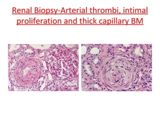 Renal Biopsy-Arterial thrombi, intimal
proliferation and thick capillary BM
 