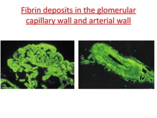 Fibrin deposits in the glomerular
capillary wall and arterial wall
 
