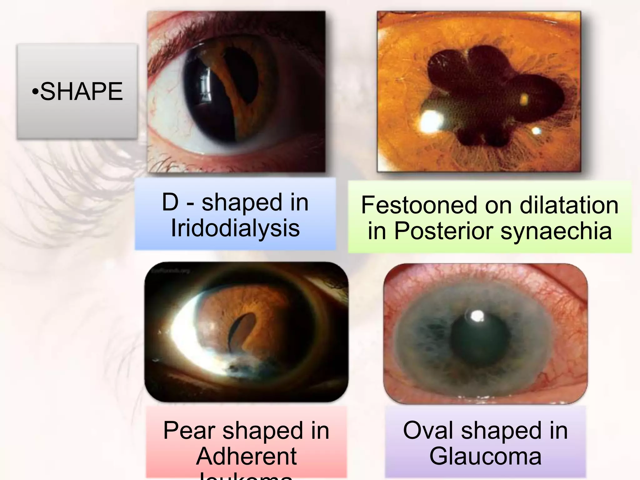 D - shaped in
Iridodialysis
Festooned on dilatation
in Posterior synaechia
Pear shaped in
Adherent
Oval shaped in
Glaucoma
•SHAPE
 