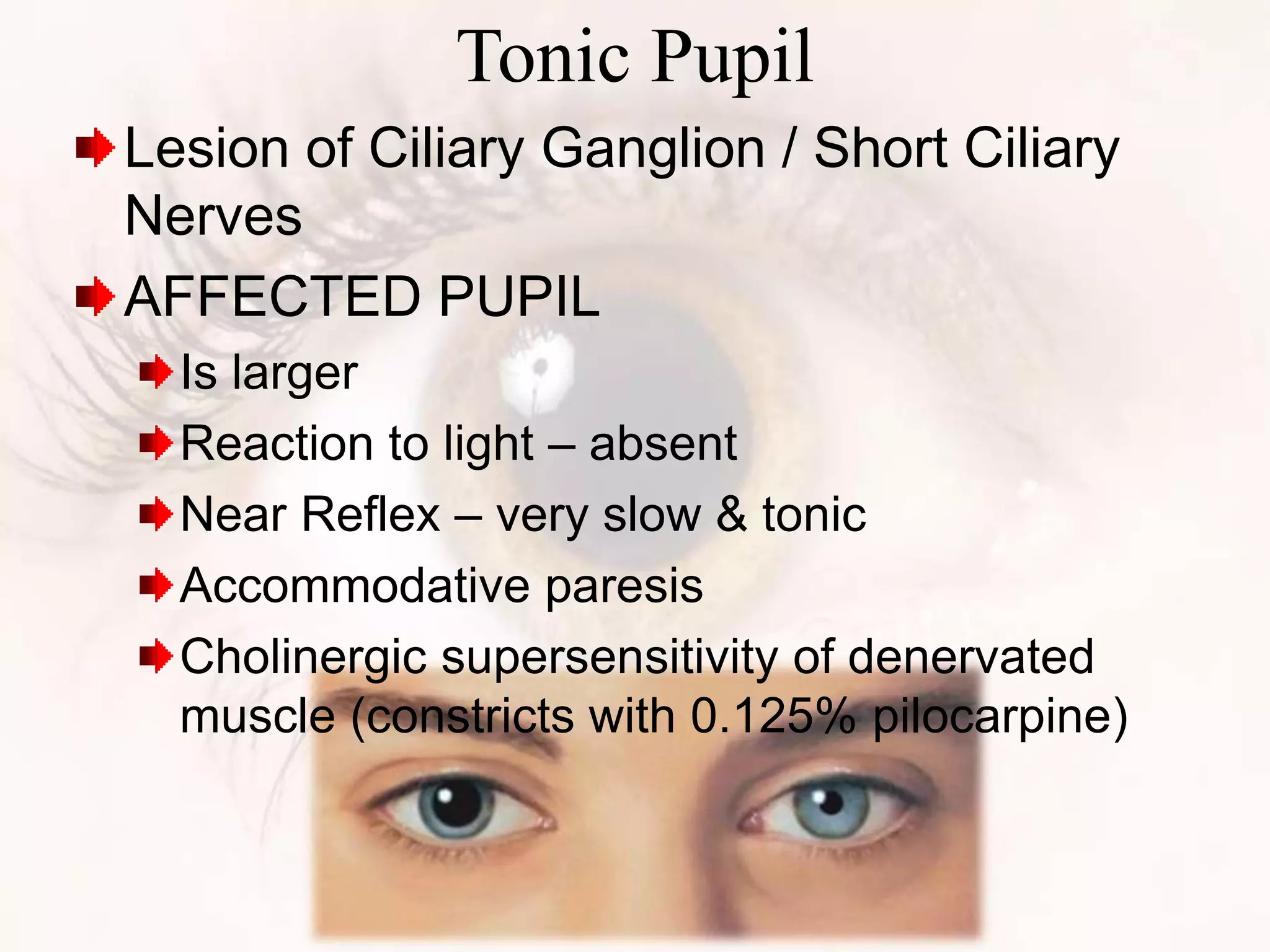 Tonic Pupil
Lesion of Ciliary Ganglion / Short Ciliary
Nerves
AFFECTED PUPIL
Is larger
Reaction to light – absent
Near Reflex – very slow & tonic
Accommodative paresis
Cholinergic supersensitivity of denervated
muscle (constricts with 0.125% pilocarpine)
 