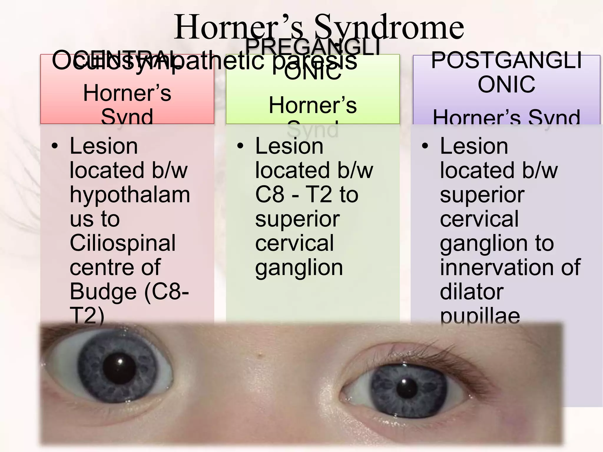 CENTRAL
Horner’s
Synd
• Lesion
located b/w
hypothalam
us to
Ciliospinal
centre of
Budge (C8-
T2)
PREGANGLI
ONIC
Horner’s
Synd
• Lesion
located b/w
C8 - T2 to
superior
cervical
ganglion
POSTGANGLI
ONIC
Horner’s Synd
• Lesion
located b/w
superior
cervical
ganglion to
innervation of
dilator
pupillae
Oculosympathetic paresis
Horner’s Syndrome
 