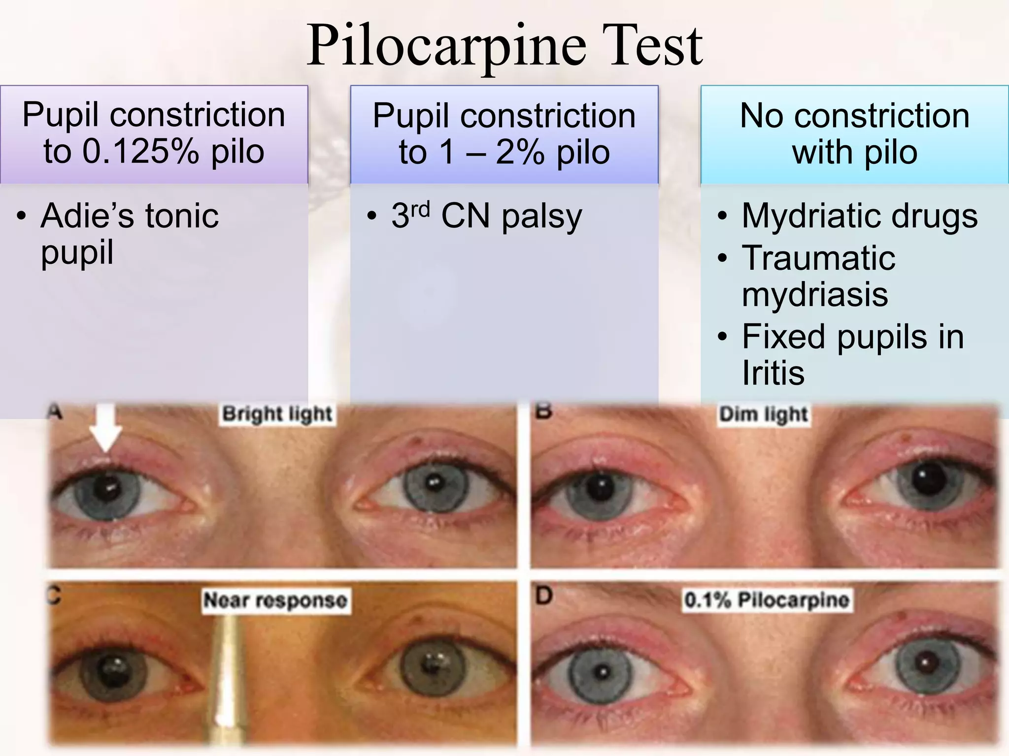 Pilocarpine Test
Pupil constriction
to 0.125% pilo
• Adie’s tonic
pupil
Pupil constriction
to 1 – 2% pilo
• 3rd CN palsy
No constriction
with pilo
• Mydriatic drugs
• Traumatic
mydriasis
• Fixed pupils in
Iritis
 