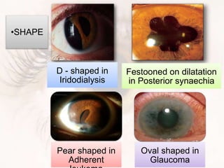 D - shaped in
Iridodialysis
Festooned on dilatation
in Posterior synaechia
Pear shaped in
Adherent
Oval shaped in
Glaucoma
•SHAPE
 
