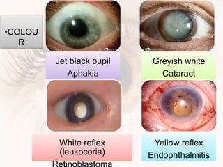 Jet black pupil
Aphakia
Greyish white
Cataract
White reflex
(leukocoria)
Yellow reflex
Endophthalmitis
•COLOU
R
 