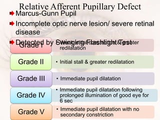 • Weak initial constriction & greater
redilatationGrade I
• Initial stall & greater redilatationGrade II
• Immediate pupil dilatationGrade III
• Immediate pupil dilatation following
prolonged illumination of good eye for
6 sec
Grade IV
• Immediate pupil dilatation with no
secondary constrictionGrade V
Relative Afferent Pupillary Defect
Marcus-Gunn Pupil
Incomplete optic nerve lesion/ severe retinal
disease
Detected by Swinging Flashlight Test
 