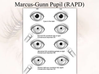 Marcus-Gunn Pupil (RAPD)
 
