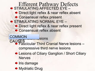 Efferent Pathway Defects
Brainstem lesions
Fascicular Third Cranial Nerve lesions –
compressive third nerve lesions
Lesions of Ciliary Ganglion / Short Ciliary
Nerves
Iris damage
Mydriatic Drug
COMMON
CAUSES
STIMULATING AFFECTED EYE –
Direct light reflex & near reflex absent
Consensual reflex present
STIMULATING NORMAL EYE –
Direct light reflex & near reflex present
Consensual reflex absent
 