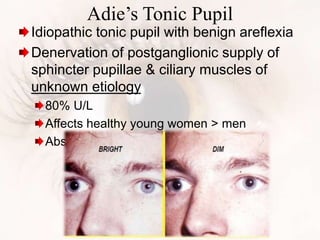 Adie’s Tonic Pupil
Idiopathic tonic pupil with benign areflexia
Denervation of postganglionic supply of
sphincter pupillae & ciliary muscles of
unknown etiology
80% U/L
Affects healthy young women > men
Absent knee jerk
 
