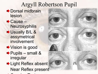 Argyll Robertson Pupil
Dorsal midbrain
lesion
Cause –
Neurosyphilis
Usually B/L &
assymetrical
involvement
Vision is good
Pupils – small &
irregular
Light Reflex absent
Near Reflex present
 